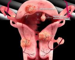 Uterine Fibroid Embolization Treatment | IR Facilities
